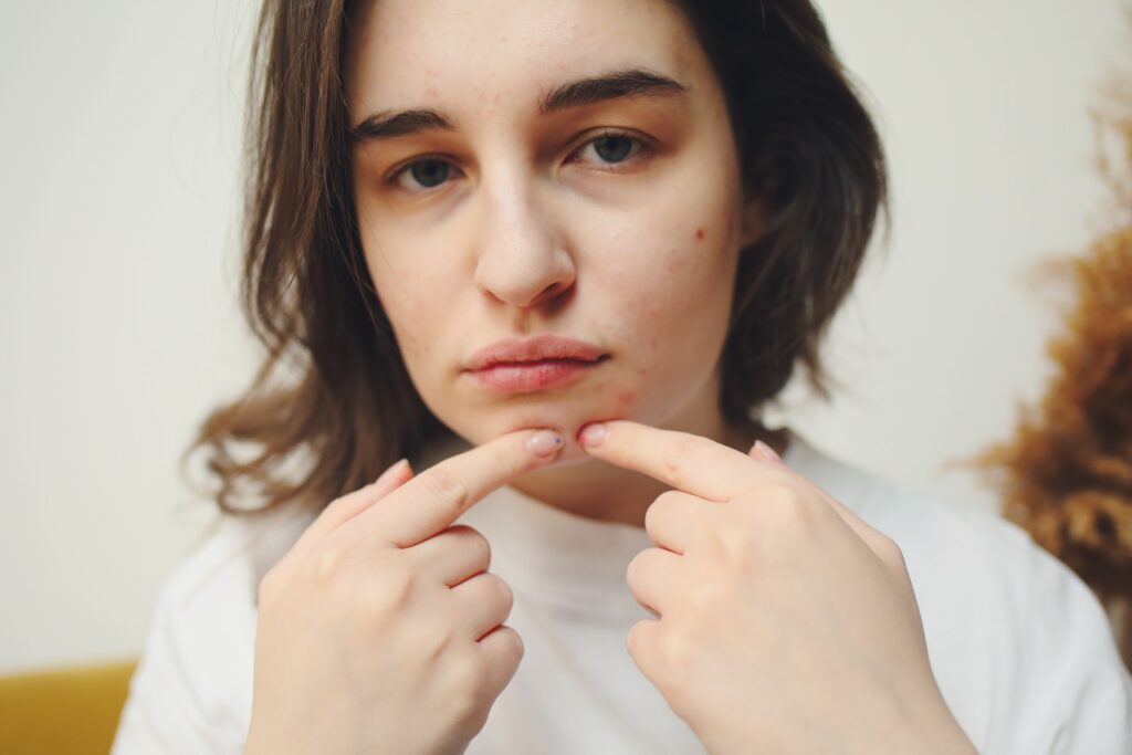 Understanding Acne: Types, Causes, and Dermatologist-Backed Treatments Understanding Acne