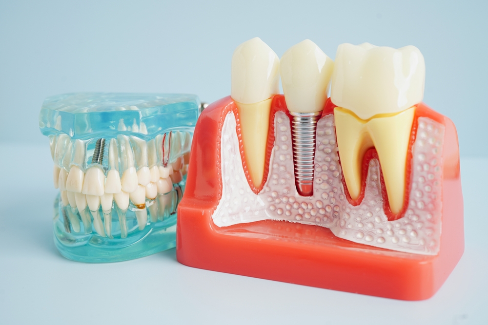 Long-term Benefits of Dental Implants Benefits of Dental Implants