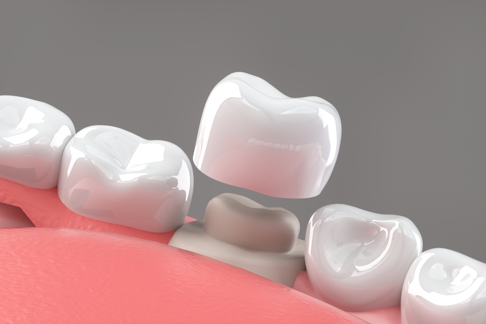 When are Dental Crowns Necessary? Dental Crowns