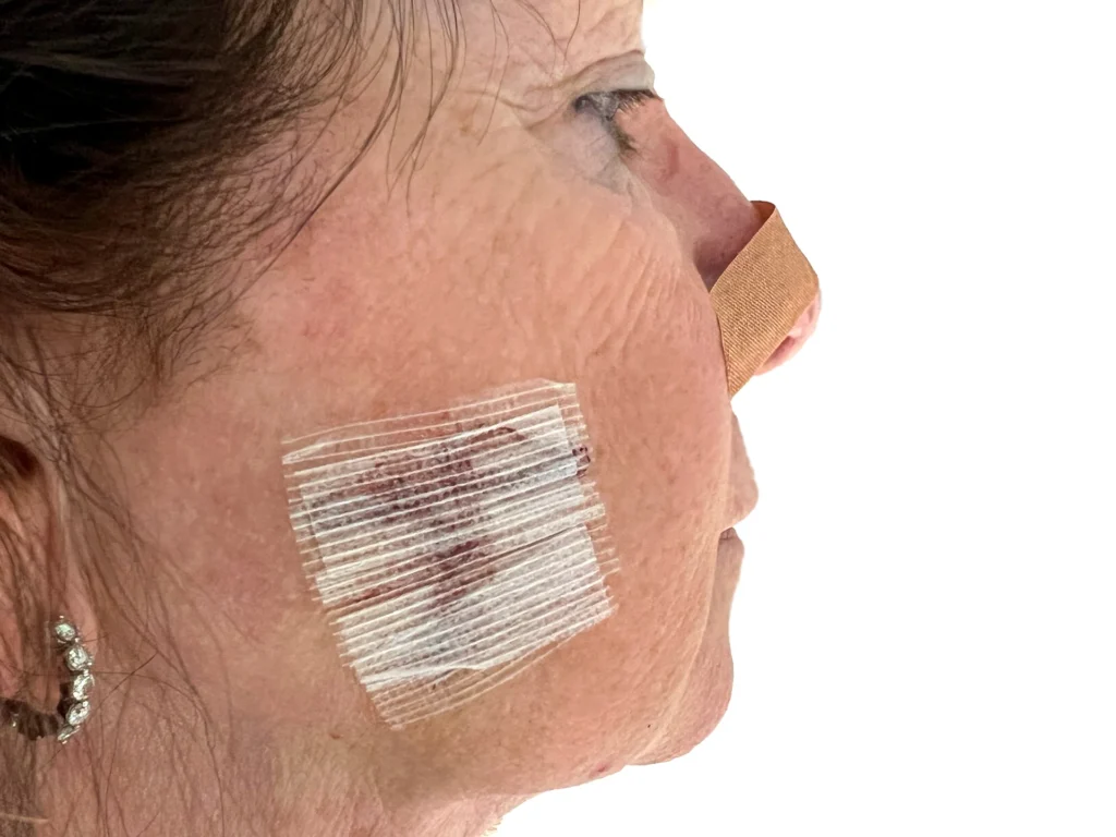 How Mohs Surgery Minimizes Scarring and Maximizes Results Mohs Surgery