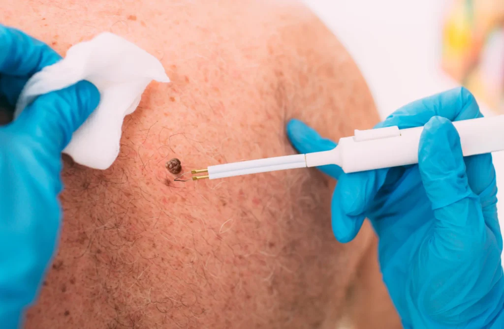 Skin Tag Removal