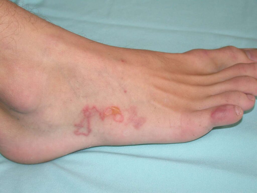 Identifying Symptoms of Skin Infections Symptoms of Skin Infections